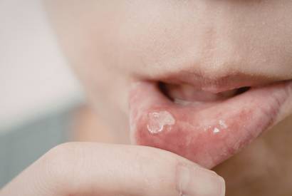 Carnaval exige aten��o redobrada com a sa�de bucal, alerta especialista