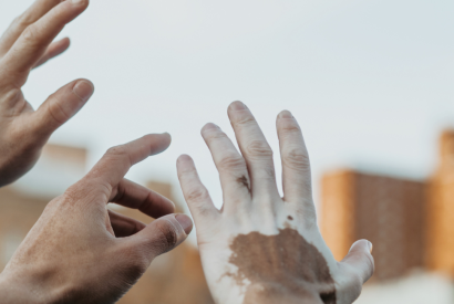 Vitiligo: SES-AM faz alerta para alto nmero de casos no estado 