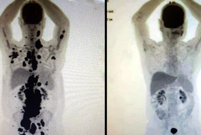 Entenda como funciona a terapia celular CAR-T Cell contra o cncer