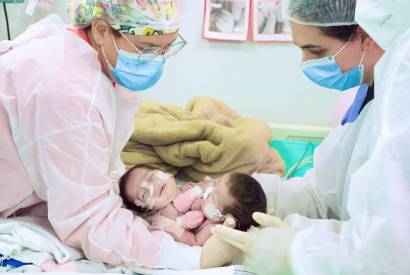 Cirurgia de separao das gmeas siamesas nascidas no Amazonas  bem-sucedida